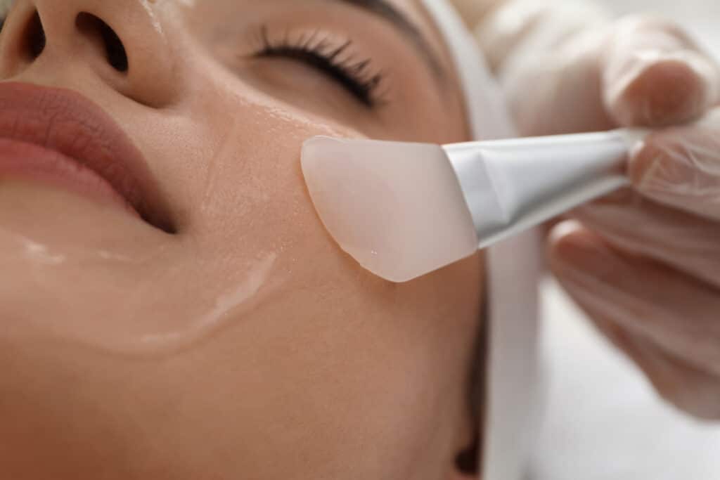 Unlocking Radiance: The Transformative Benefits of Chemical Peels